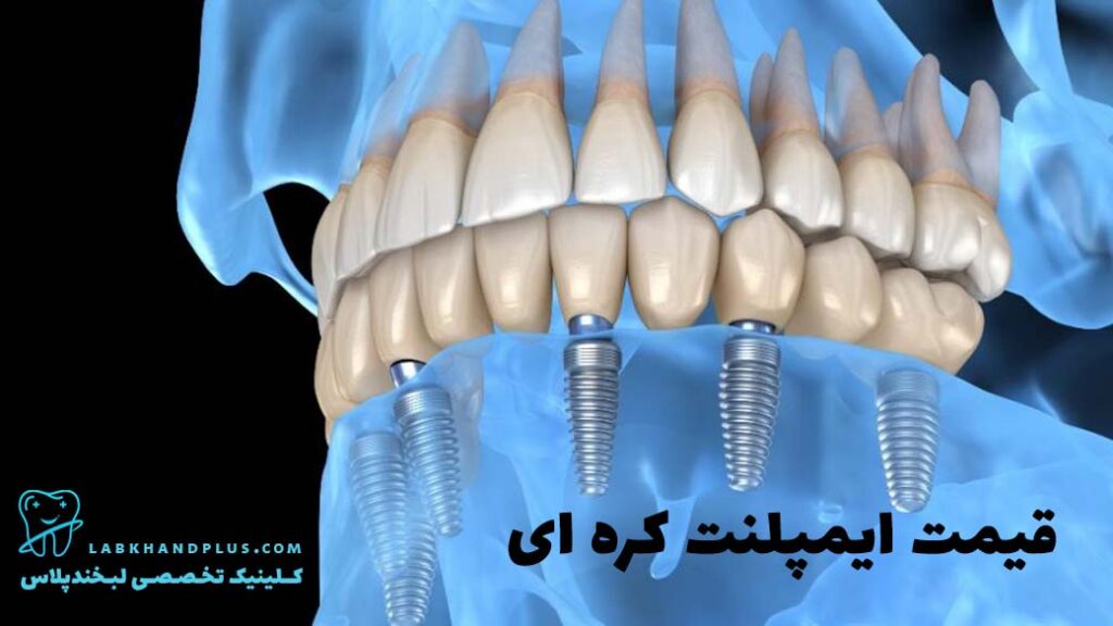 ایمپلنت دندان کره ای