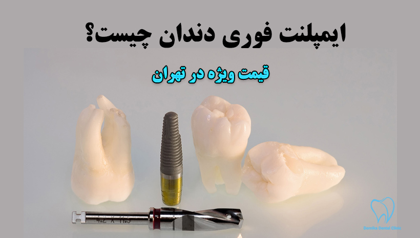 ایمپلنت فوری چیست
