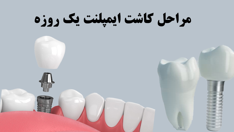 مراحل کاشت ایمپلنت یک روزه