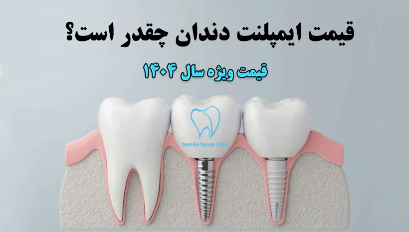 قیمت ایمپلنت دندان 1404 (هزینه ایمپلنت در تهران + ضمانت کتبی) 2 هزینه ایمپلنت دندان در تهران