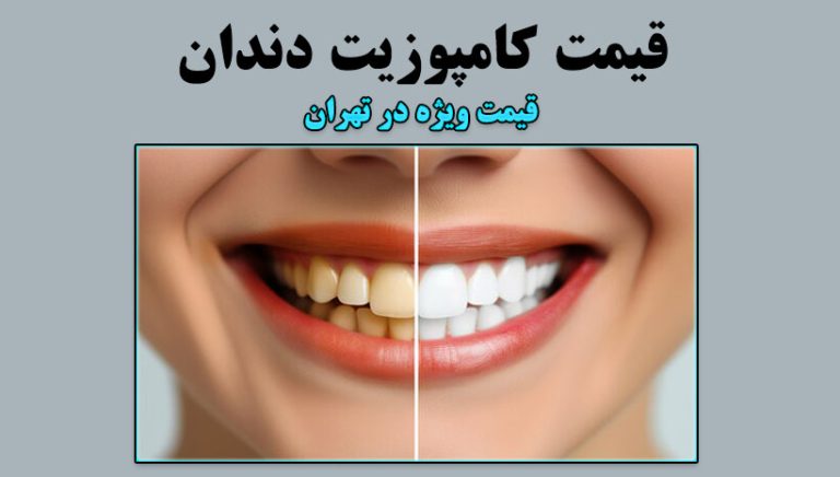 وبلاگ درنیکا 1 قیمت کامپوزیت دندان در تهران